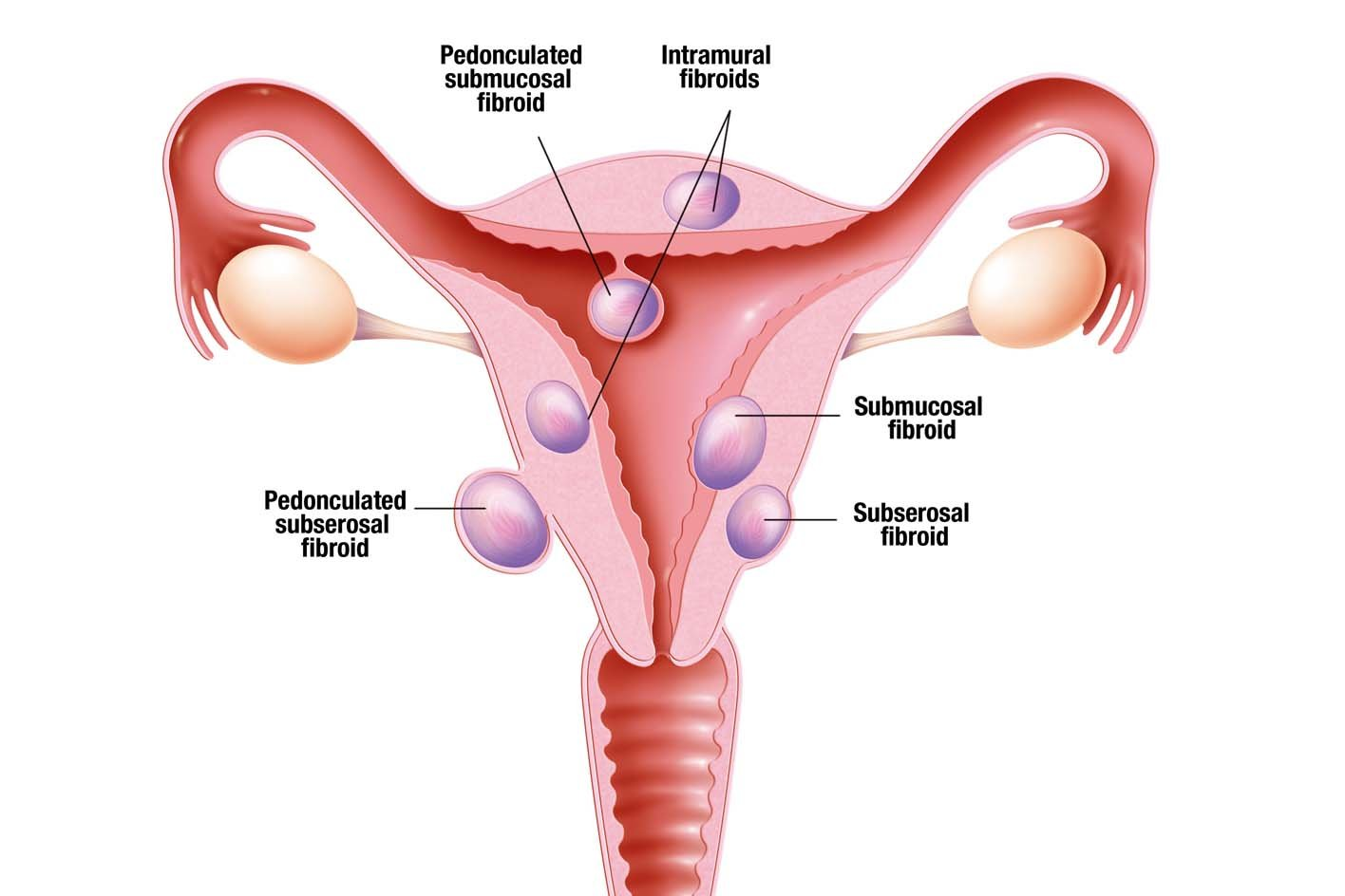 Fibroids