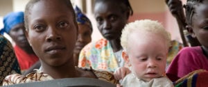 Un enfant atteint d'albinisme porté par sa mère. Photo : ONU.