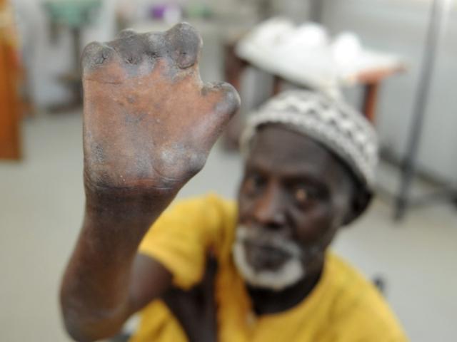 Un patient sénégalais, âgé de 77 ans, montre ses mains après avoir reçu un traitement qui l’a guéri de la lèpre, au Centre hospitalier de l'Ordre de Malte à Dakar, le 20 janvier 2014. SEYLLOU / AFP